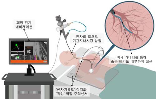 분당서울대병원, '네비게이션 폐암 진단기술' 첫 도입